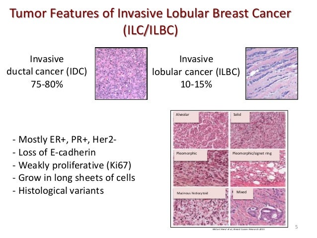 lobular invasive breast cancer Lobular invasive breast cancer